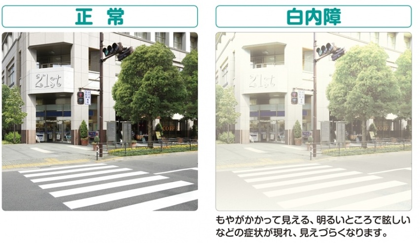 白内障セルフチェック