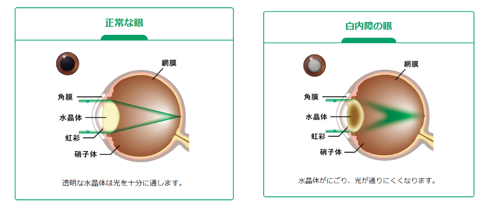 白内障とは