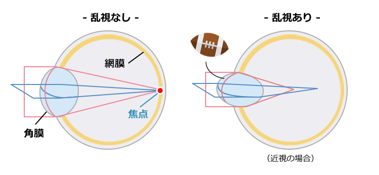 正乱視（ICL（眼内コンタクト）で矯正可能）