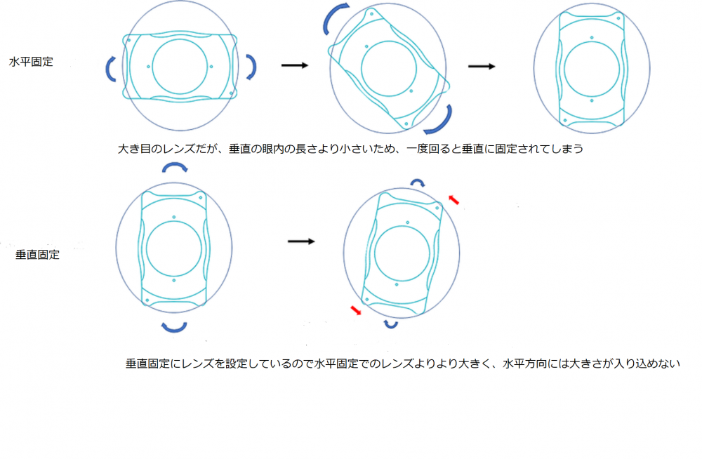 垂直固定は、ICL（眼内コンタクト）が安定しやすい理由