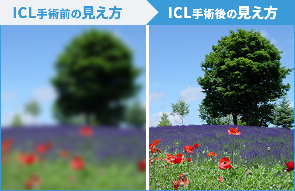 ICL　手術前の見え方/手術後の見え方